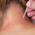 How Does Dry Needling Restore Mobility - chiropractor in metairie