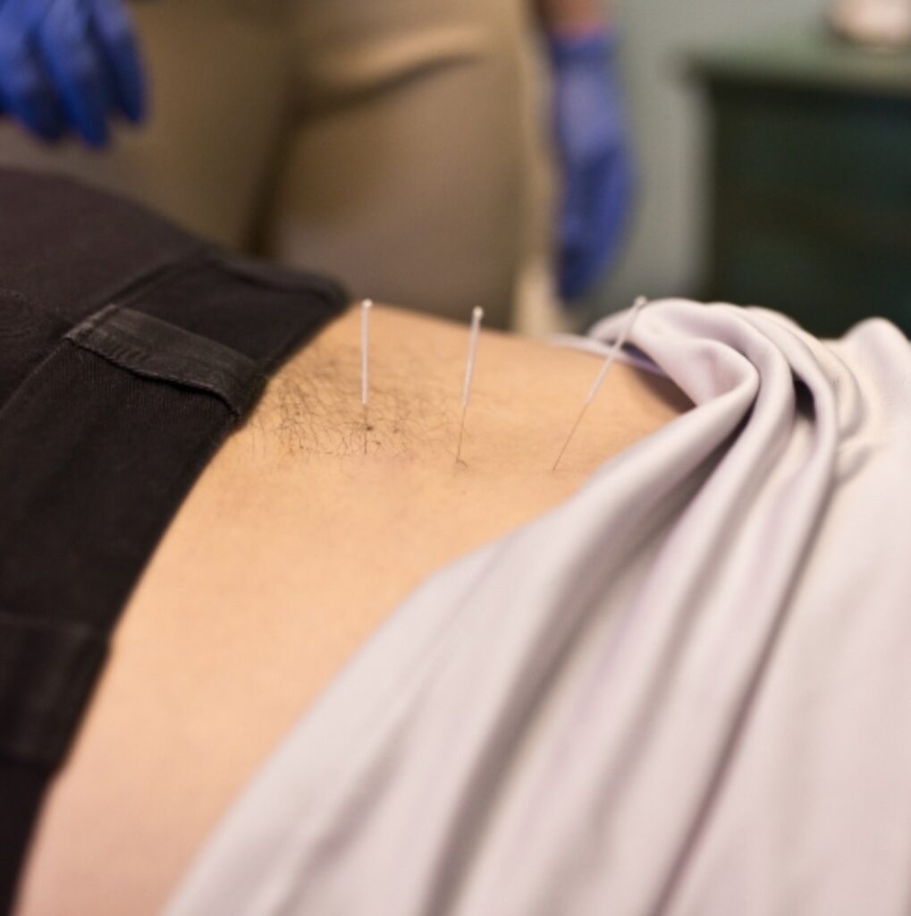 What Can Dry Needling Treat A Look at Its Most Common Benefits - chiropractor in metairie